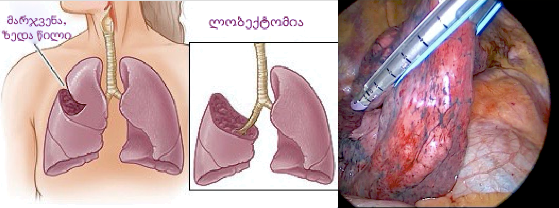 თორაკოსკოპიული ლობექტომია